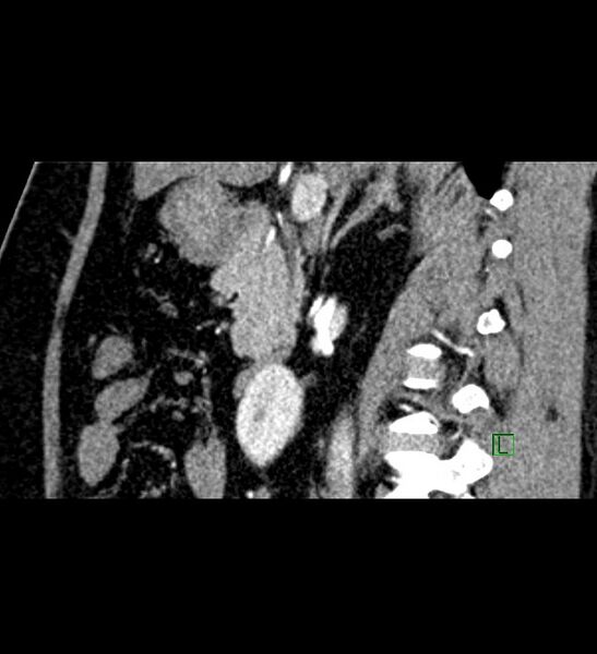 File:Chromophobe renal cell carcinoma (Radiopaedia 84286-99573 F 100).jpg