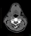 Chronic Submandibular sialolithiasis (Radiopaedia 16880-16606 Axial non-contrast 19).jpg