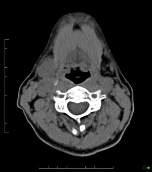 File:Chronic Submandibular sialolithiasis (Radiopaedia 16880-16606 Axial non-contrast 19).jpg