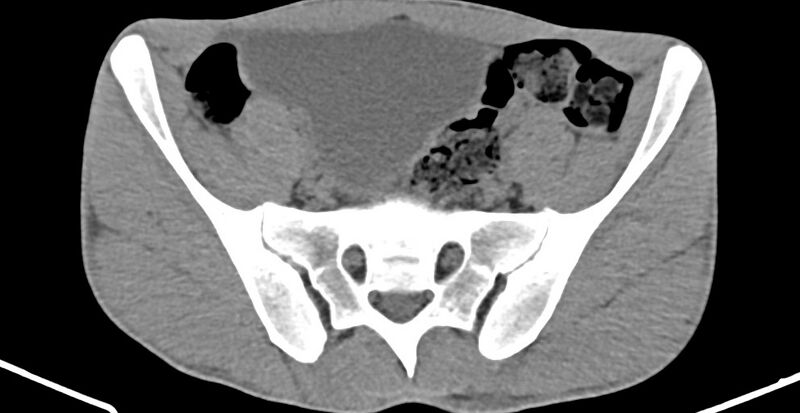 File:Chronic osteomyelitis (with sequestrum) (Radiopaedia 74813-85822 Axial 408).jpg