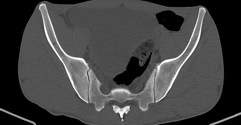 File:Chronic osteomyelitis (with sequestrum) (Radiopaedia 74813-85822 Axial non-contrast 15).jpg
