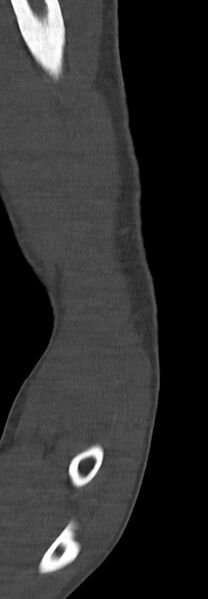 File:Chronic osteomyelitis of the distal humerus (Radiopaedia 78351-90971 Sagittal bone window 34).jpg