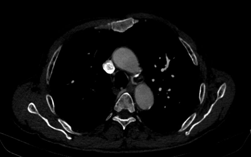 File:Chronic pulmonary embolism (Radiopaedia 91241-108843 B 60).jpg