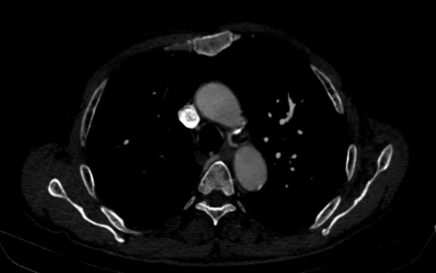 Chronic pulmonary embolism (Radiopaedia 91241-108843 B 60).jpg