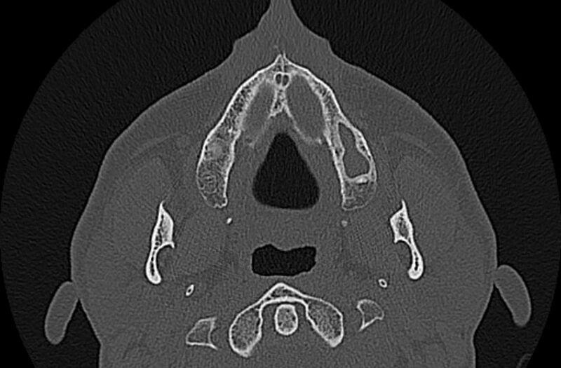 File:Chronic rhinosinusitis (Radiopaedia 65079-74075 Axial bone window 5).jpg