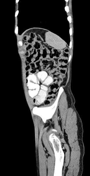 File:Chronic small bowel volvulus (Radiopaedia 75224-86322 C 28).jpg