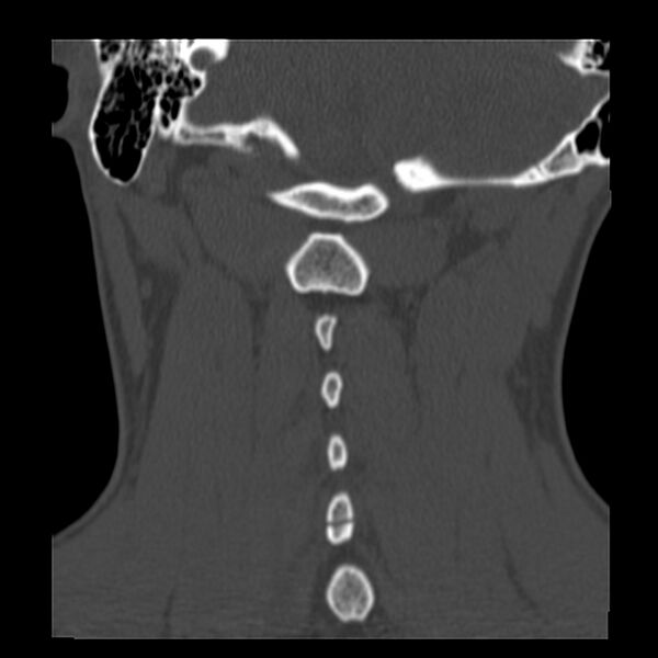 File:Clay-shoveler fracture (Radiopaedia 22568-22590 Coronal bone window 28).jpg