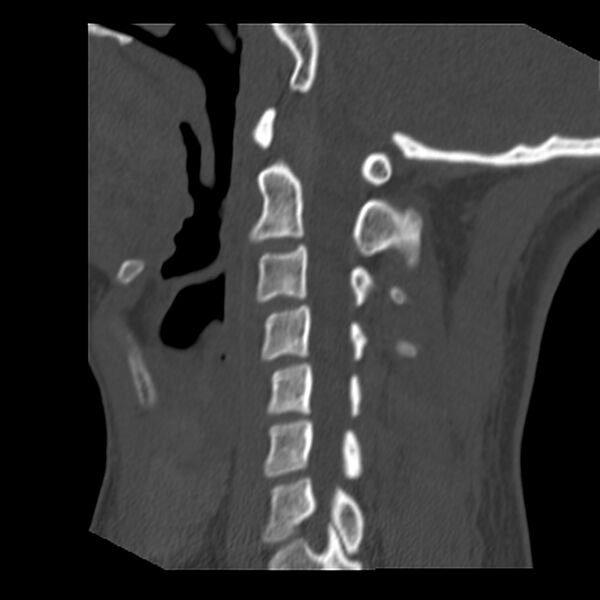 File:Clay-shoveler fracture (Radiopaedia 22568-22590 Sagittal bone window 16).jpg