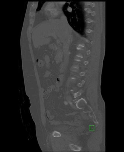 File:Clear cell renal cell carcinoma (Radiopaedia 85006-100539 Sagittal bone window 36).jpg