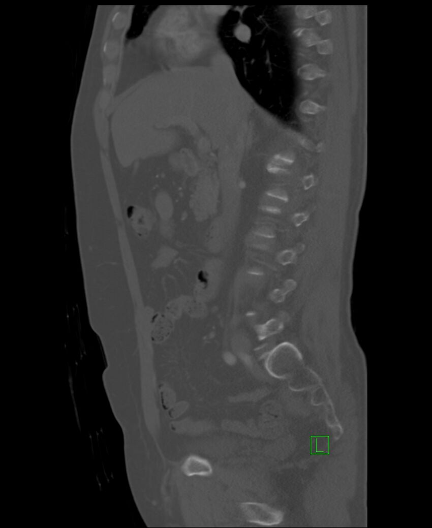Clear cell renal cell carcinoma (Radiopaedia 85006-100539 Sagittal bone window 36).jpg