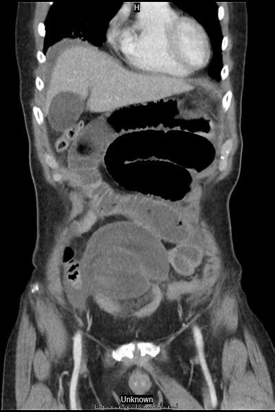 File:Closed loop bowel obstruction and ischemia (Radiopaedia 86959-103180 B 7).jpg