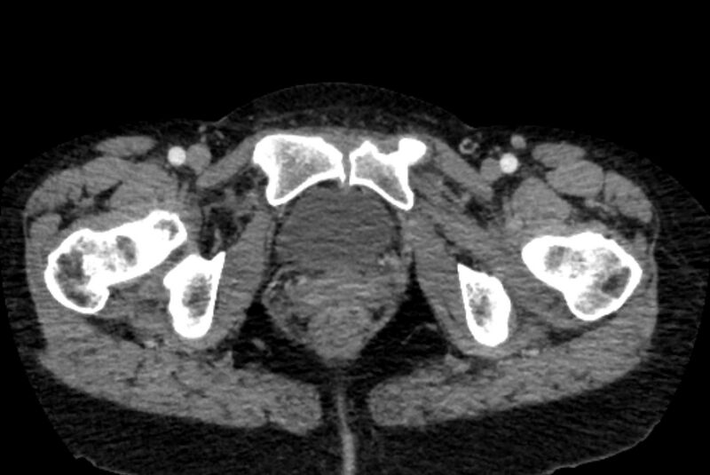 File:Closed loop small bowel obstruction (Radiopaedia 71211-81508 A 172).jpg