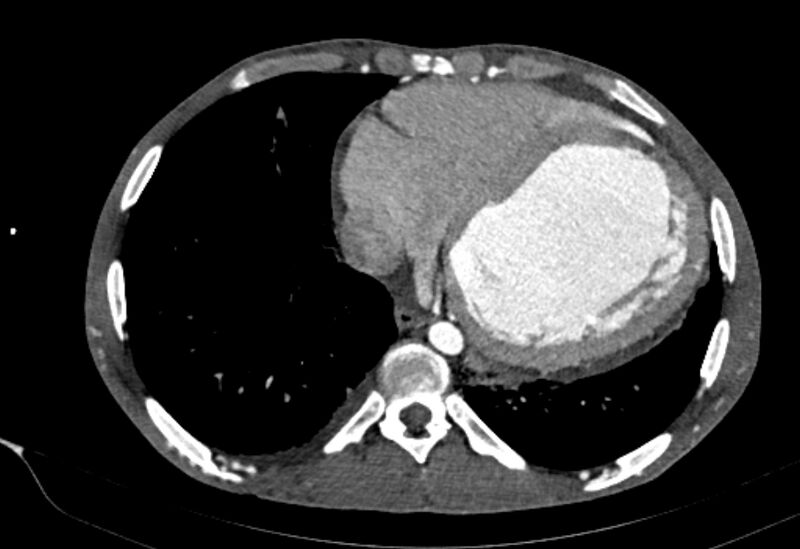 File:Coarctation of aorta with aortic valve stenosis (Radiopaedia 70463-80574 A 162).jpg