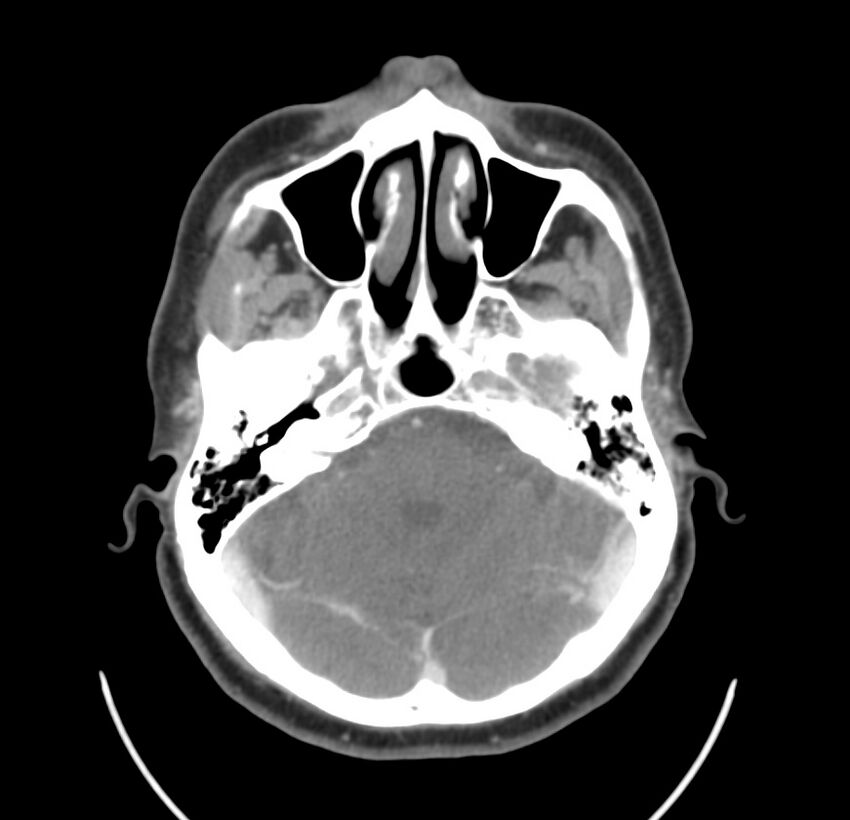 Colloid cyst of thyroid (Radiopaedia 22897-22923 Axial C+ delayed 8).jpg