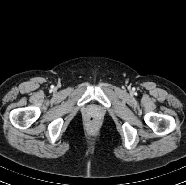 File:Colon carcinoma with hepatic metastases (Radiopaedia 29477-29961 A 120).jpg