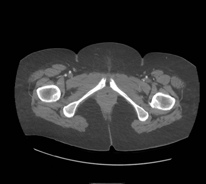 File:Colonic pseudo-obstruction (Radiopaedia 79752-92980 A 198).png
