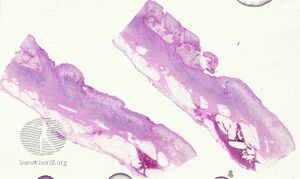 Blastomycosis-like pyoderma/pathology