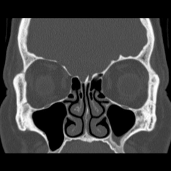 File:Nasolabial cyst (Radiopaedia 33987-35205 Coronal bone window 35).jpg