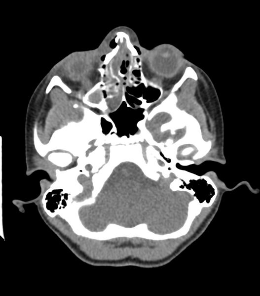 File:Nasoorbitoethmoid fracture (Radiopaedia 90044-107205 Axial non-contrast 146).jpg