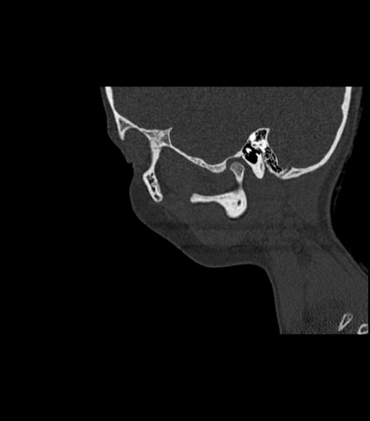 File:Nasoorbitoethmoid fracture (Radiopaedia 90044-107205 Sagittal bone window 34).jpg
