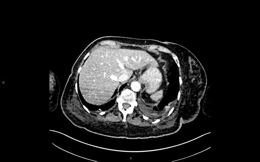 Neo-terminal ileal stricture (Crohn disease) (Radiopaedia 33790-34948 A 64).jpg