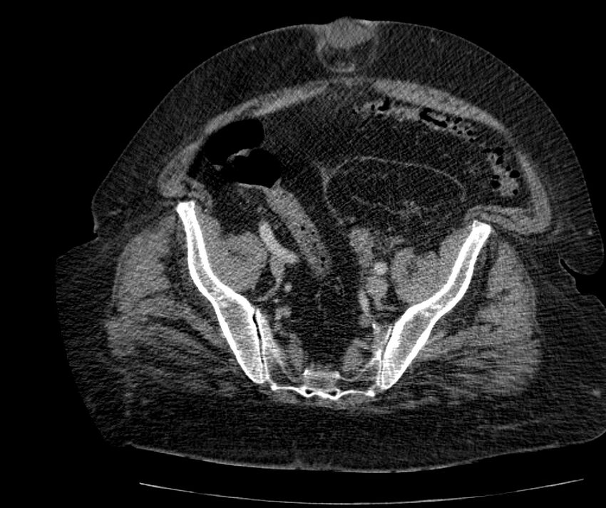 Nephroptosis with inguinal hernia containing perirenal fat (Radiopaedia 56632-63391 C 275).jpg