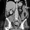 Nerve sheath tumor - malignant - sacrum (Radiopaedia 5219-6987 B 6).jpg