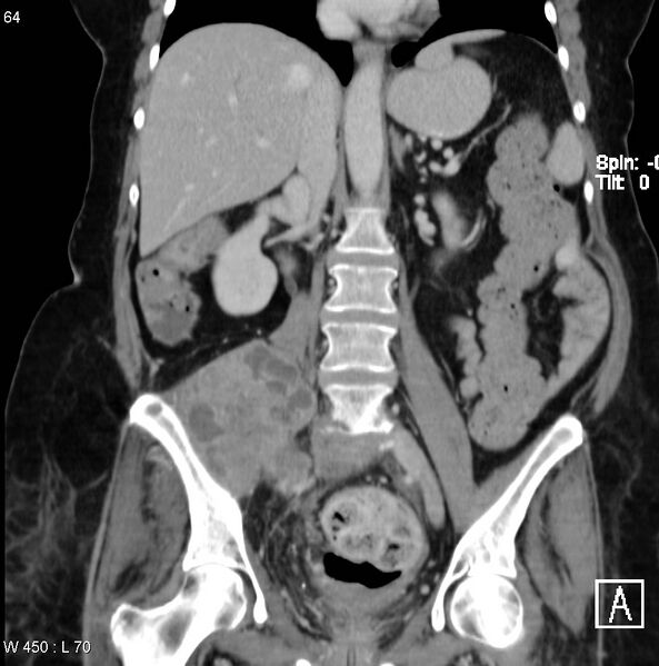 File:Nerve sheath tumor - malignant - sacrum (Radiopaedia 5219-6987 B 6).jpg