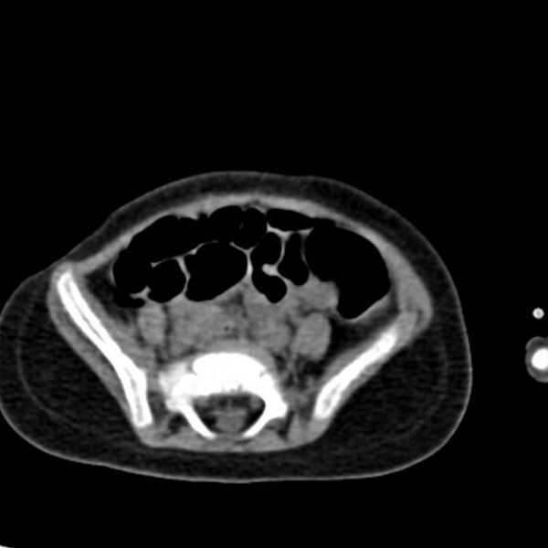 File:Neuroblastoma with skull metastases (Radiopaedia 30326-30960 Axial non-contrast 45).jpg