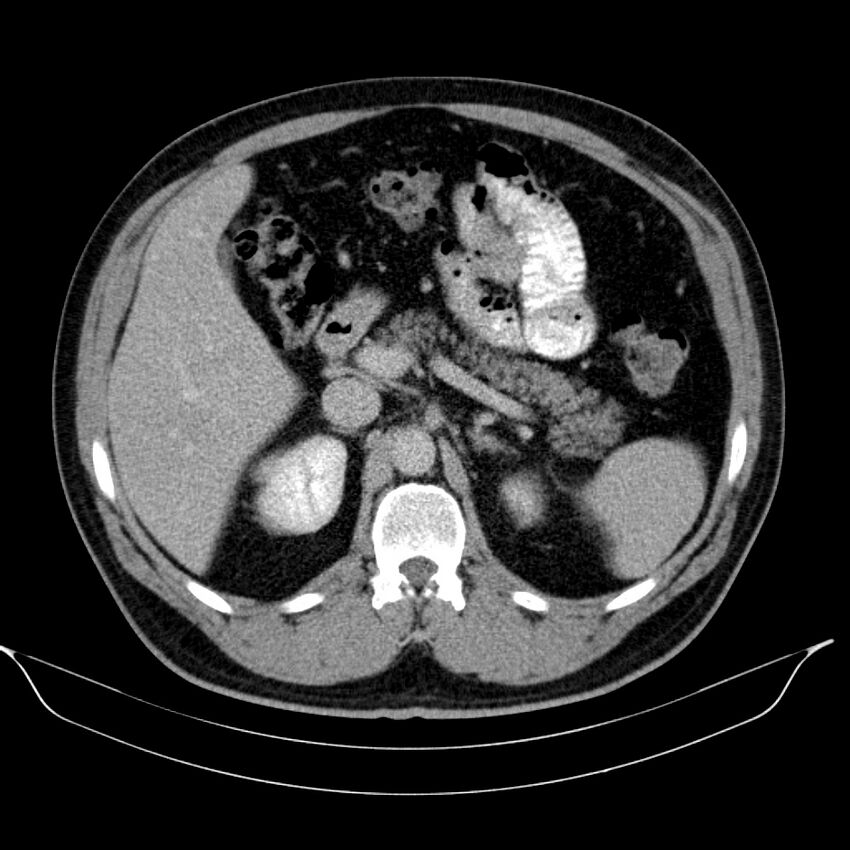 Neuroendocrine tumor of head of pancreas (Radiopaedia 57538-64502 D 28).jpg