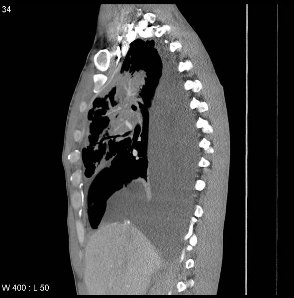 File:Non-Hodgkin lymphoma involving lung (Radiopaedia 29094-29470 D 25).jpg