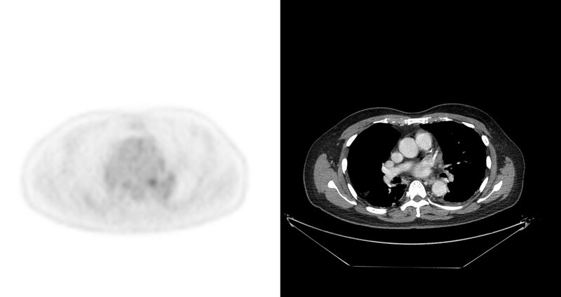 File:Non-Hodgkin lymphoma involving seminal vesicles with development of interstitial pneumonitis during Rituximab therapy (Radiopaedia 32703-33675 axial PET CT 47).jpg