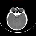 Non-accidental injury - bilateral subdural with acute blood (Radiopaedia 10236-10765 Axial non-contrast 7).jpg