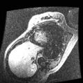 Non-compaction of the left ventricle (Radiopaedia 38868-41062 E 6).jpg