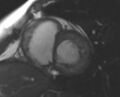 Non-compaction of the left ventricle (Radiopaedia 69436-79314 Short axis cine 143).jpg