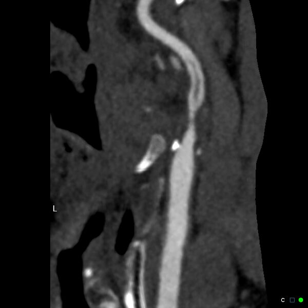 File:Non-occlusive intraluminal internal carotid artery thrombus (Radiopaedia 37751-39658 A 42).jpg