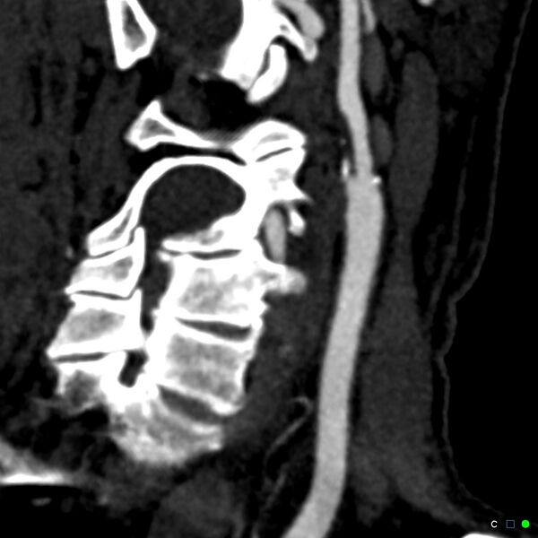 File:Non-occlusive intraluminal internal carotid artery thrombus (Radiopaedia 37751-39658 C 6).jpg