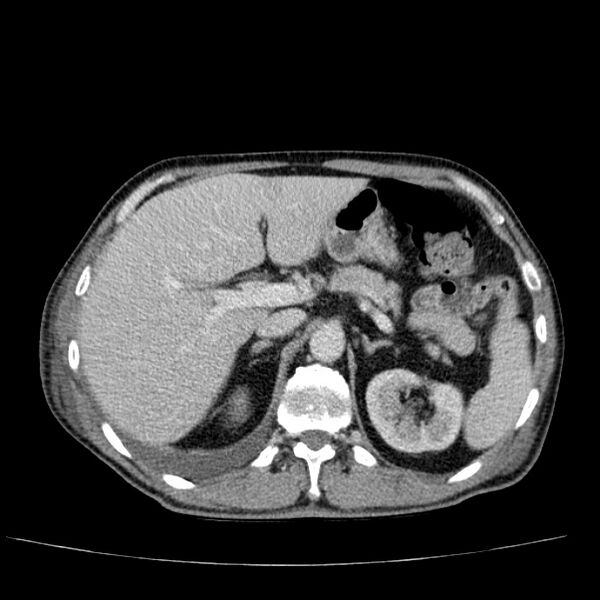File:Non small-cell lung cancer (Radiopaedia 24467-24769 C+ delayed 62).jpg