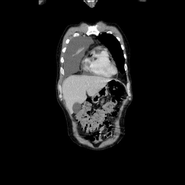 File:Non small-cell lung cancer (Radiopaedia 24467-24769 Coronal C+ delayed 12).jpg