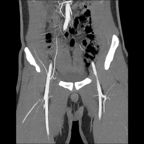 File:Normal CT angiogram of pelvis (Radiopaedia 45390-49430 B 17).jpg