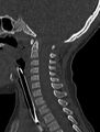 Normal CT cervical spine - pediatric (Radiopaedia 52549-58462 Sagittal bone window 102).jpg