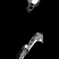 Normal CT of the neck (Radiopaedia 14575-14500 Sagittal C+ 5).jpg