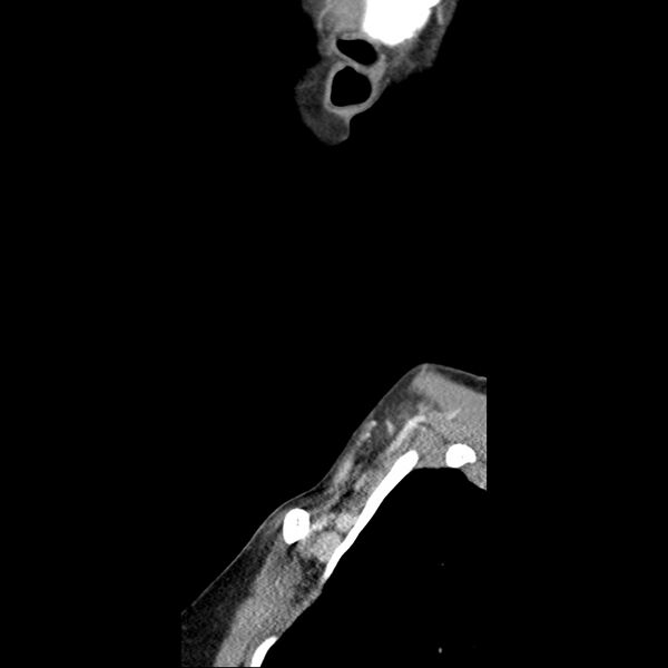 File:Normal CT of the neck (Radiopaedia 14575-14500 Sagittal C+ 5).jpg
