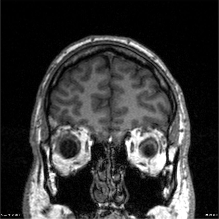 Normal brain MRI (non-focal epilepsy protocol) (Radiopaedia 38571-40700 Coronal T1 88).jpg