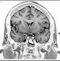 Normal coronal brain (Radiopaedia 6676-7910 B 16).jpg