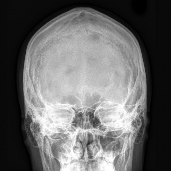 File:Normal skull (Radiopaedia 8301-9144 Frontal 1).jpg
