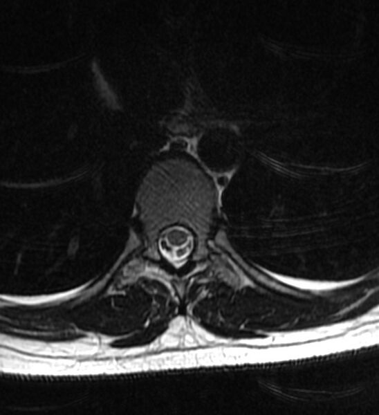 File:Normal thoracic spine MRI (Radiopaedia 41033-43781 Axial T2 9).jpg