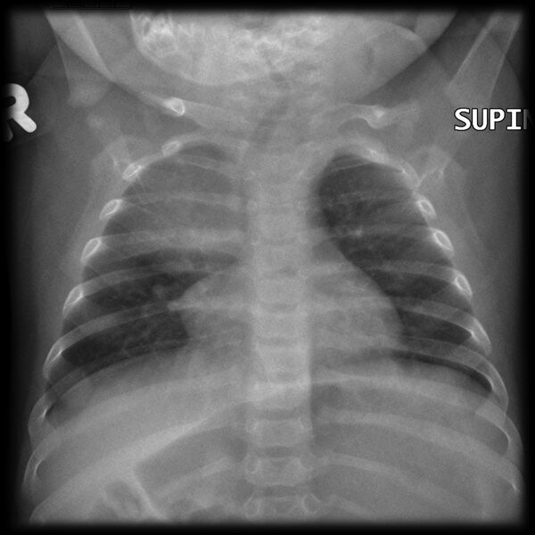 File:Normal thymus - right sided (Radiopaedia 8281-9130 Frontal 1).jpg