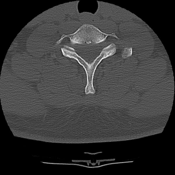 File:Normal trauma spine imaging (Radiopaedia 31753-32686 Axial bone window 67).jpg