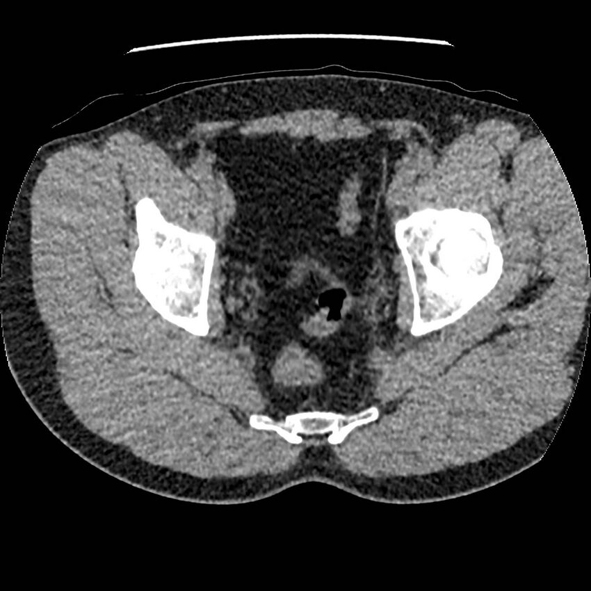 Obstructing ureteric calculus and ureteric anatomy (Radiopaedia 62730-71042 Axial non-contrast 151).jpg